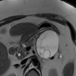 Pancreatic Cystic Lesions: Diagnostic, Management and Indications for Operation. Part II