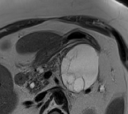 Pancreatic Cystic Lesions: Diagnostic, Management and Indications for Operation. Part II