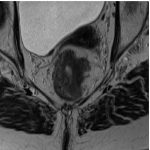 The Importance of Preoperative Staging of Rectal Cancer Using multiparametric MRI Part II