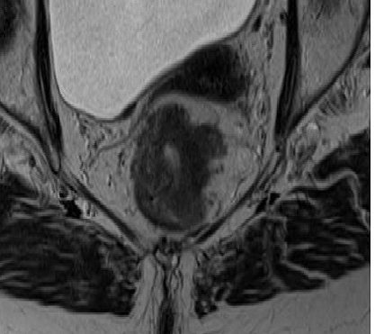 The Importance of Preoperative Staging of Rectal Cancer Using multiparametric MRI Part II: TNM Cancer Staging
