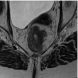 The Importance of Preoperative Staging of Rectal Cancer Using multiparametric MRI Part II
