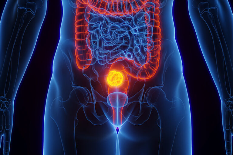 Update rectal cancer symposium – 2019